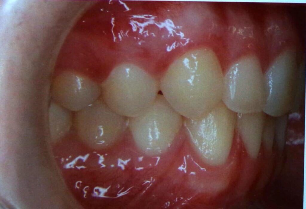 Fotografia intraoral mostrando a oclusão e o bom encaixe dos dentes do paciente