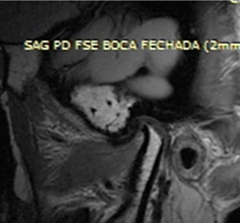 Ressonância da ATM mostrando grande reabsorção da cabeça da mandíbula com cortical óssea muito fina