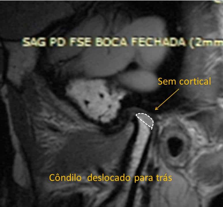 Ressonância da ATM com linha pontilhada indicando a quantidade de osso perdida na cabeça da mandíbula