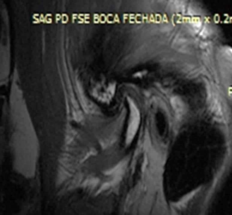 Ressonância da ATM com setas indicando o deslocamento da cabeça da mandíbula para trás, em direção ao ouvido