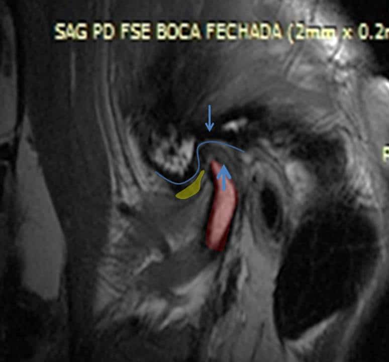 Ressonância da ATM destacando a posição atual da cabeça da mandíbula em relação à posição ideal