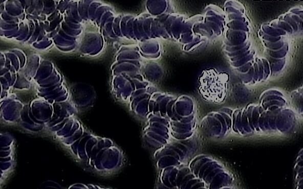 Microscopia de sangue vivo mostrando rouleaux de eritrócitos em paciente com disfunção da ATM