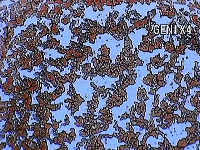 Microscopia mostrando estresse oxidativo severo com vacúolos em eritrócitos