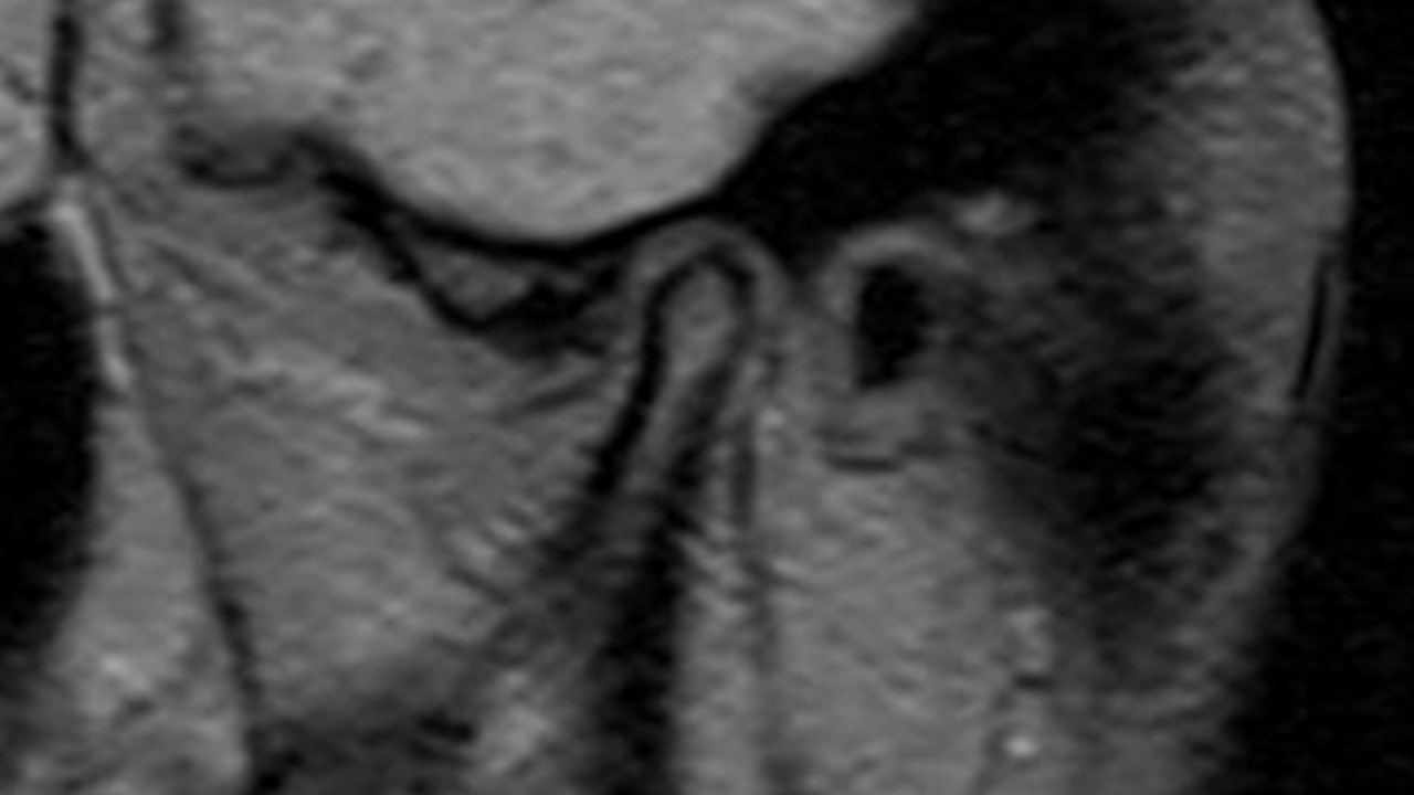 Ressonância magnética da ATM mostrando côndilo mandibular com superfície regular e contorno saudável, porém com disco articular deslocado anteriormente sem redução. Imagem evidencia que estrutura óssea preservada não exclui disfunção interna da articulação temporomandibular.